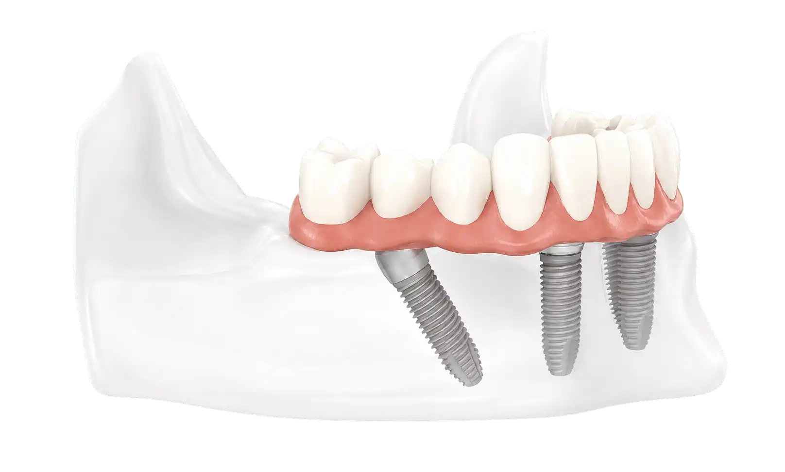 Seitliche Ansicht einer Zahnbrücke auf Implantaten